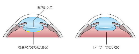 後発白内障手術のイメージ